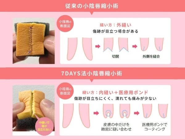 ダウンタイムを大幅に軽減！7days法小陰唇縮小術とは？